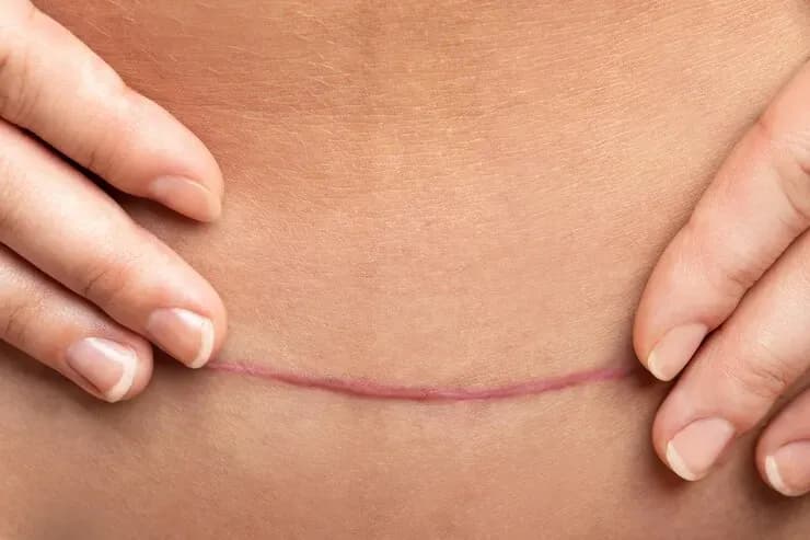 O que preciso saber sobre Cicatrizes antes de uma Cirurgia Plástica?