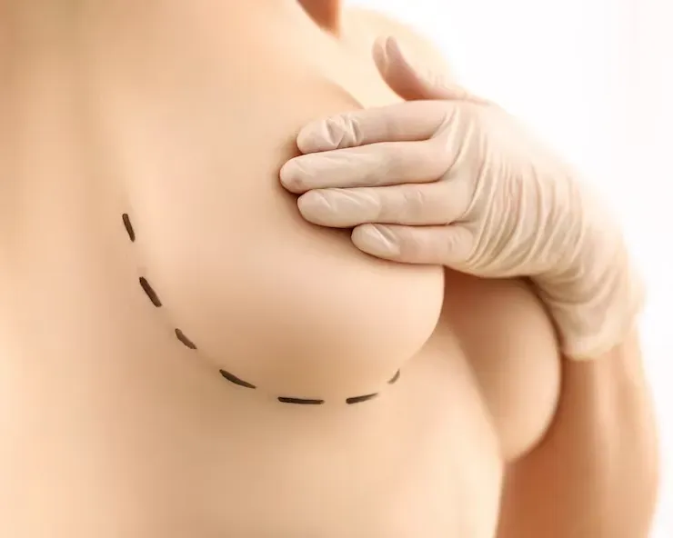Causas comuns da retirada da Prótese de Silicone Mamária