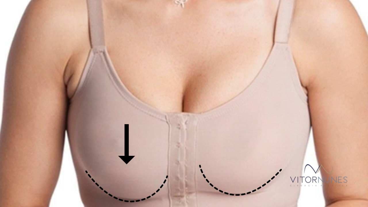Deslocamento de Prótese de Silicone
