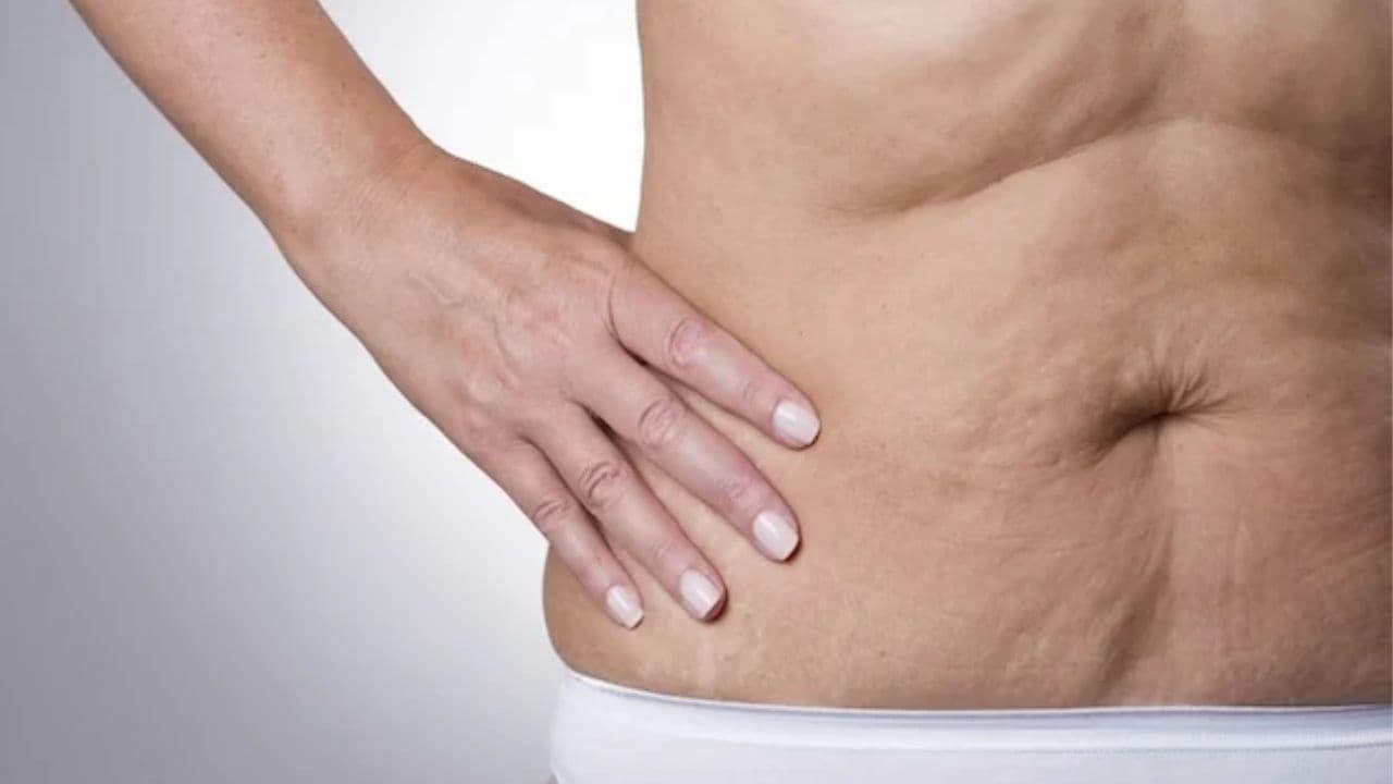 Como posso tratar a flacidez abdominal?