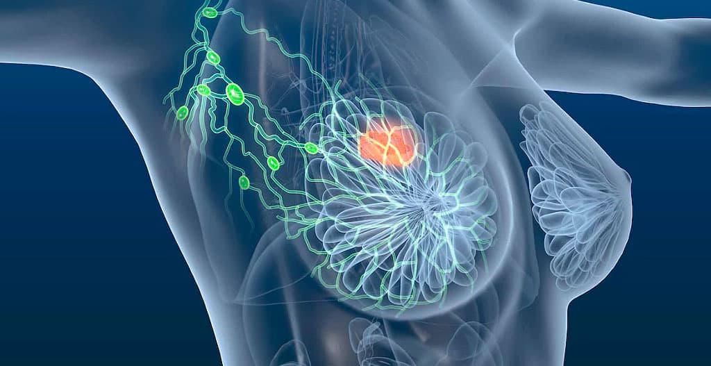 Cirurgia plástica e Câncer de Mama: o que preciso saber!!!