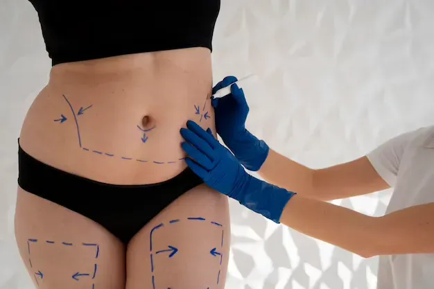 É comum necessitar do retoque após Lipoaspiração?