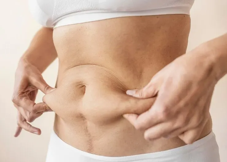 Lipoaspiração e Hidrolipo, quais as diferenças?