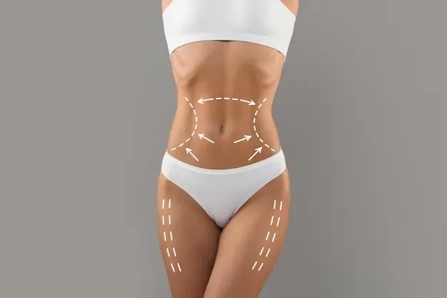 Lipoaspiração HD: uma das “queridinhas” entre as cirurgias plásticas