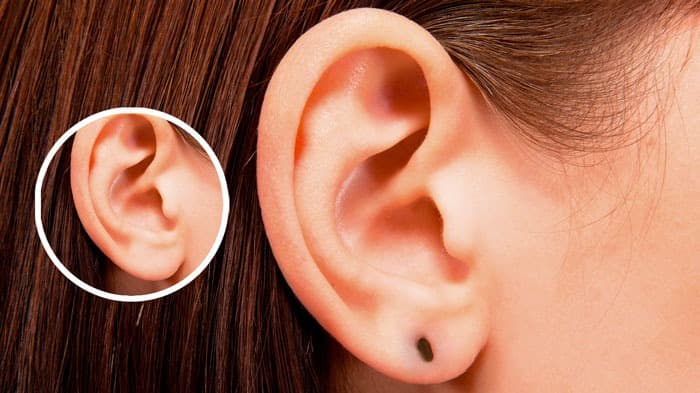 Lobuloplastia: cirurgia plástica para orelha rasgada