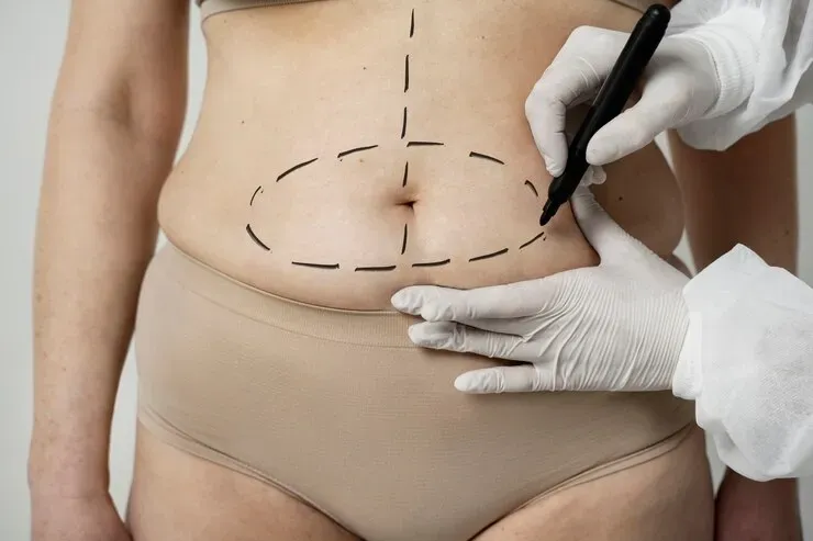 Lipoaspiração ou Abdominoplastia: Qual o melhor procedimento para você?