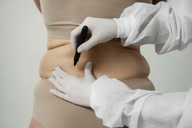 5 Curiosidades sobre Lipoaspiração