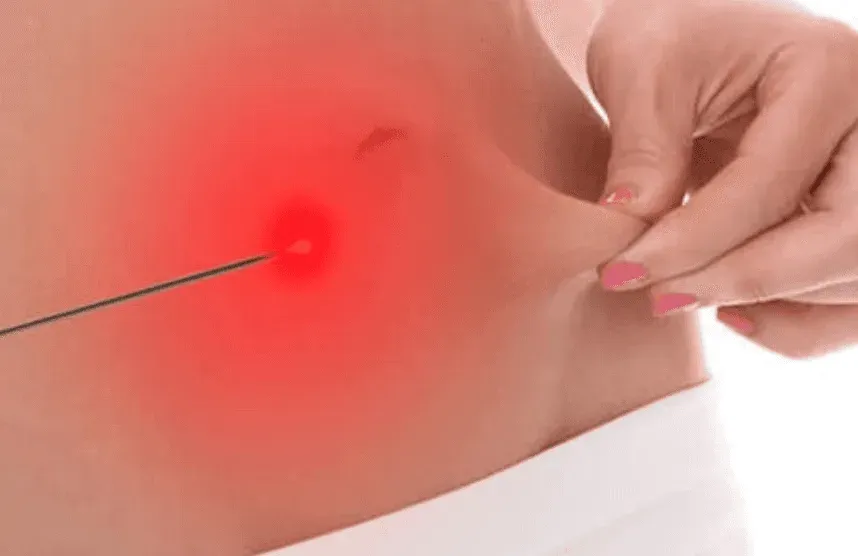 Laser (Luz) — Lipo HD