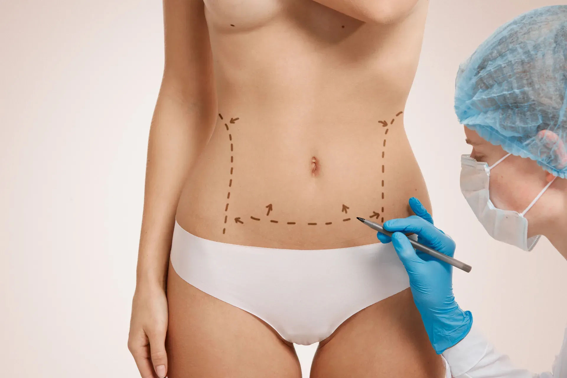 ABDOMINOPLASTIA — Contorno corporal