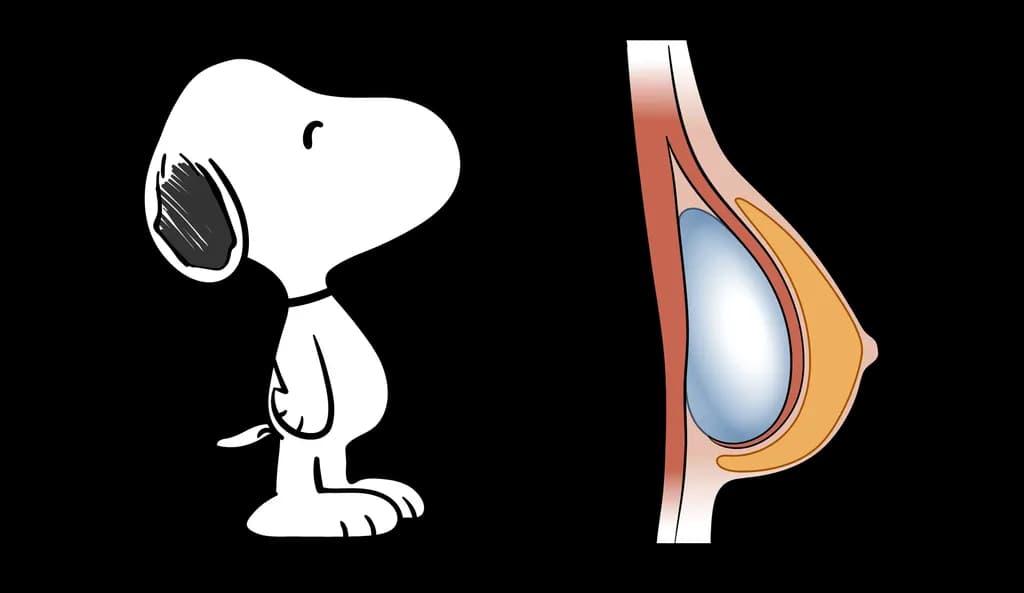 "Snoopy" na Cirurgia Mamária