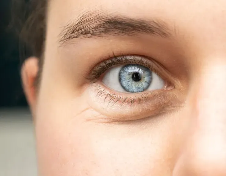 Blefaroplastia Inferior sem corte: Uma abordagem minimamente invasiva para revitalizar seu olhar