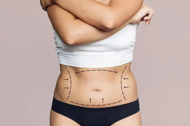 Já ouviu falar em Abdominoplastia Estendida?