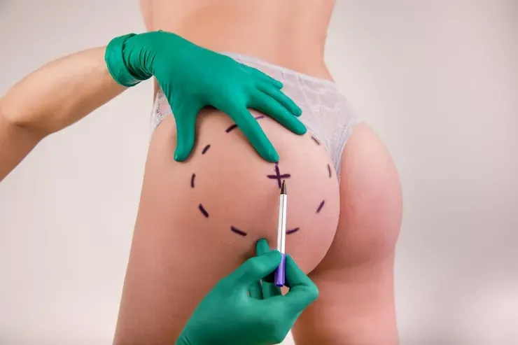 Saiba mais sobre Lifting Glúteo
