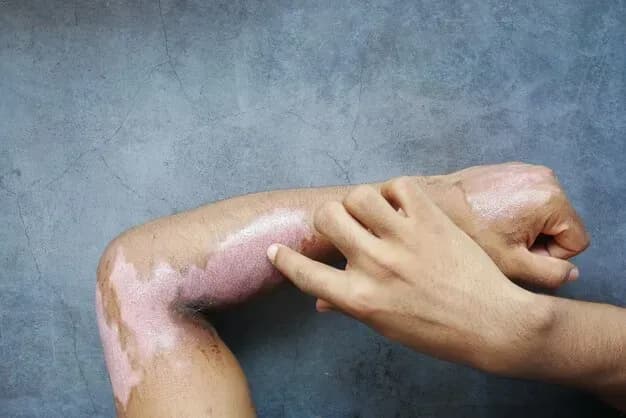 Queimadura e Cirurgia Plástica Reparadora