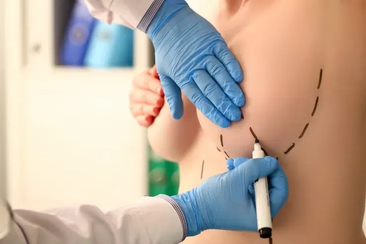 Mastopexia Short Scar, saiba mais sobre essa técnica