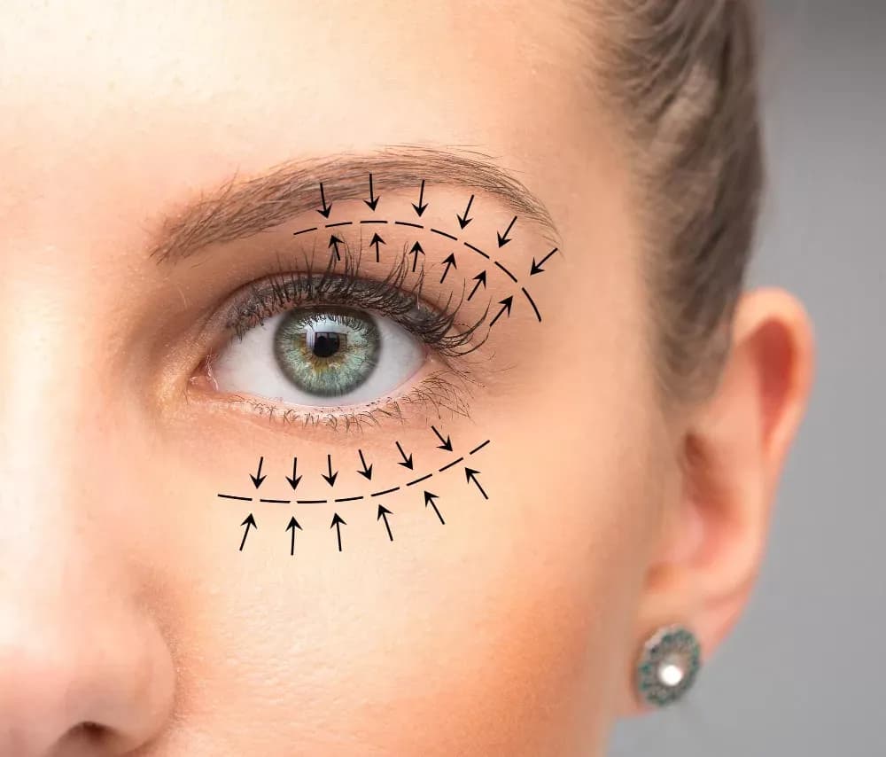 Blefaroplastia: Saiba tudo sobre a cirurgia das pálpebras