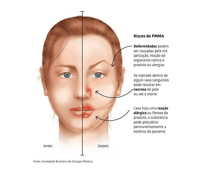 Preenchimento com PMMA e seus riscos