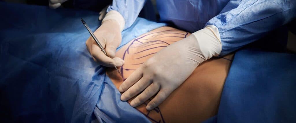 Abdominoplastia: Como é Feita, Recuperação e Valor 2025