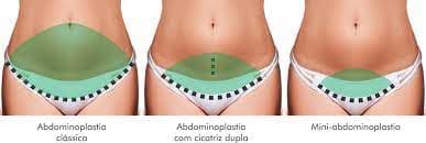 Abdominoplastia: Como é Feita, Recuperação e Valor 2025