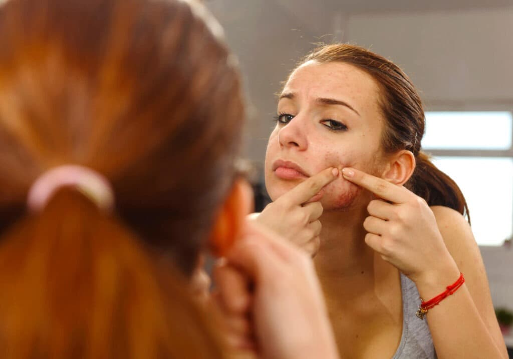 Saiba tudo sobre Cicatriz de Acne