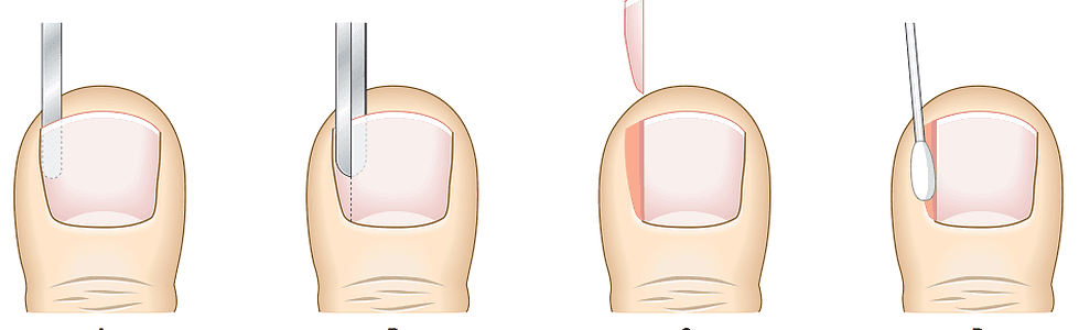Saiba mais sobre Cirurgia de Unha Encravada
