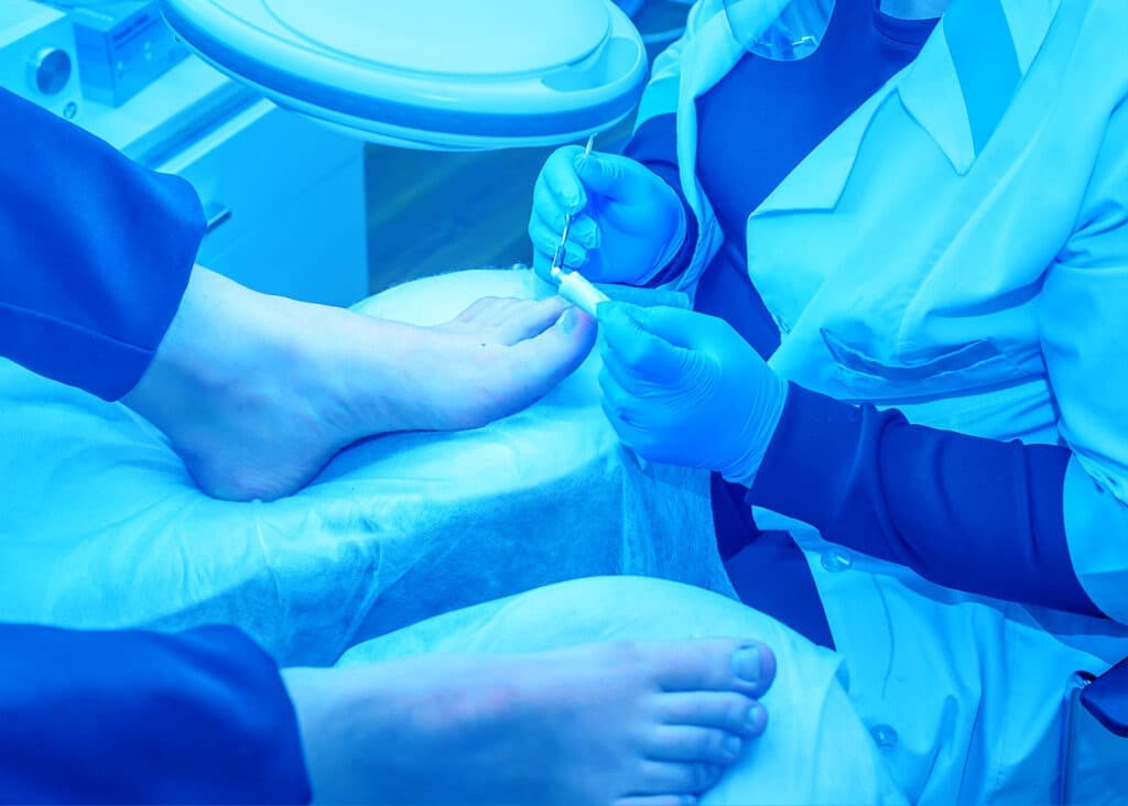 Saiba mais sobre Cirurgia de Unha Encravada