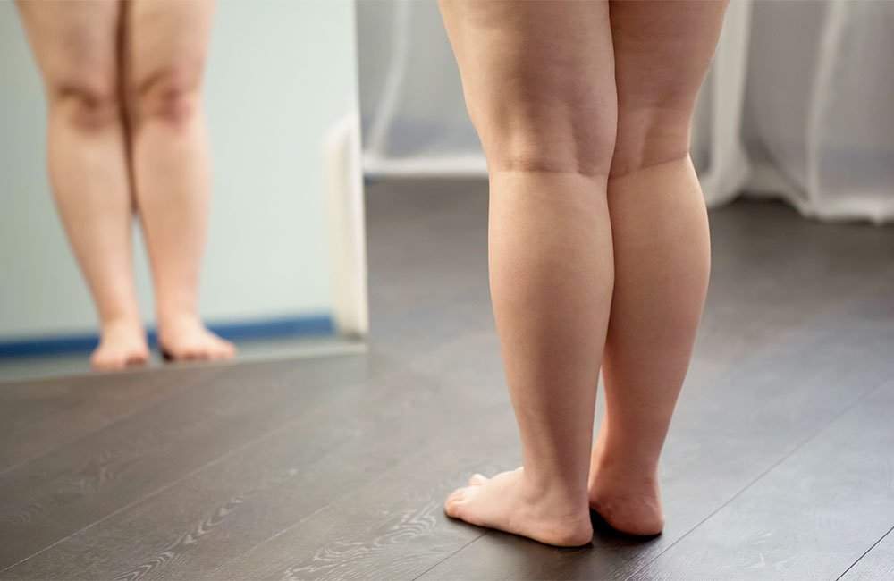 Lipedema_o_que_e_quais_sintomas_e-tratamento
