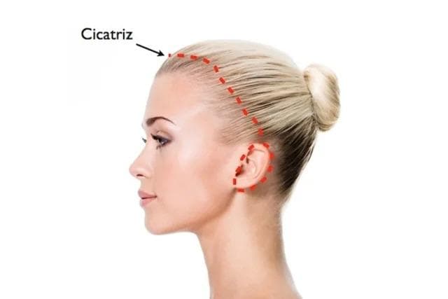 Saiba tudo sobre Lifting facial