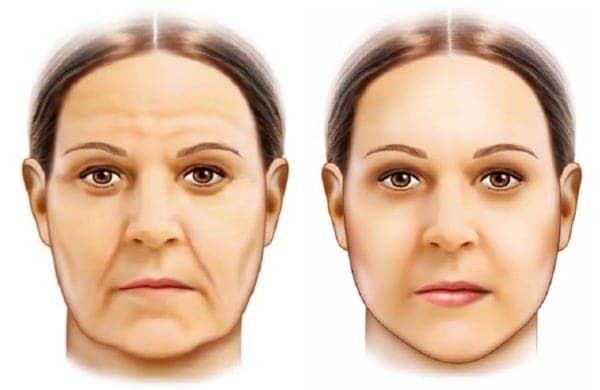 Saiba tudo sobre Lifting facial