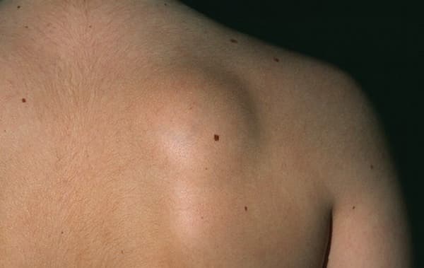 Saiba mais sobre Lipoma e seus tratamentos