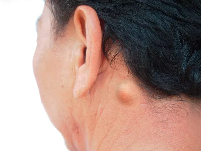 Saiba mais sobre Lipoma e seus tratamentos