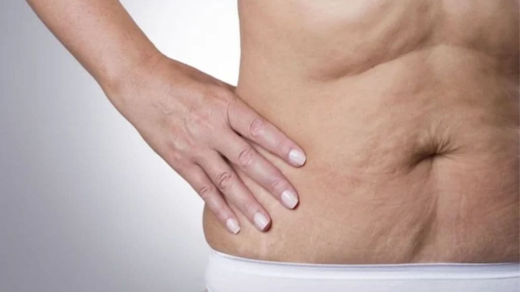 Como posso tratar a flacidez abdominal?
