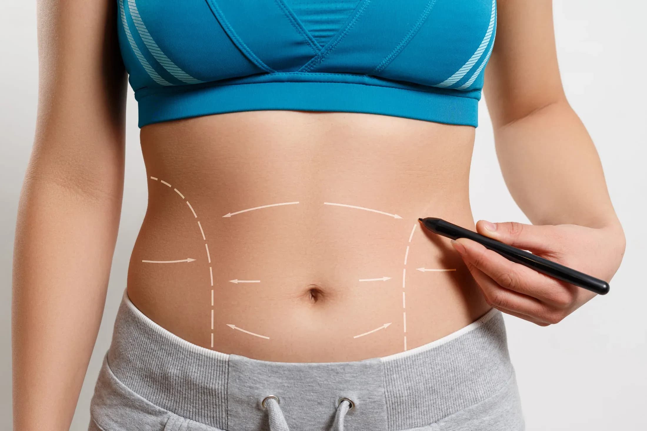 Como fica o umbigo após a abdominoplastia