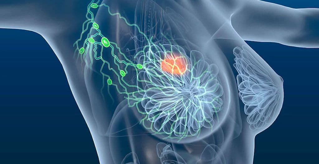 Cirurgia plástica e Câncer de Mama: o que preciso saber!!!