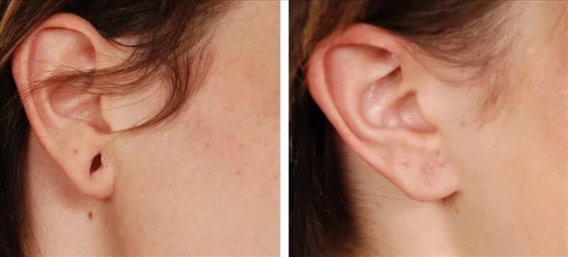 Lobuloplastia: cirurgia plástica para orelha rasgada
