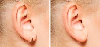Lobuloplastia: cirurgia plástica para orelha rasgada