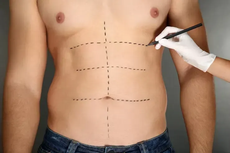 Lipoaspiração em Homens: entenda como funciona