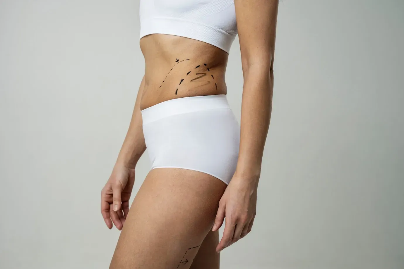 Diferença entre lipoaspiração e lipoescultura
