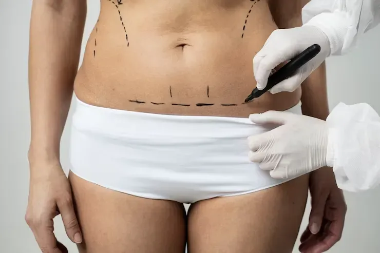 Lipoaspiração com Enxerto nos Glúteos