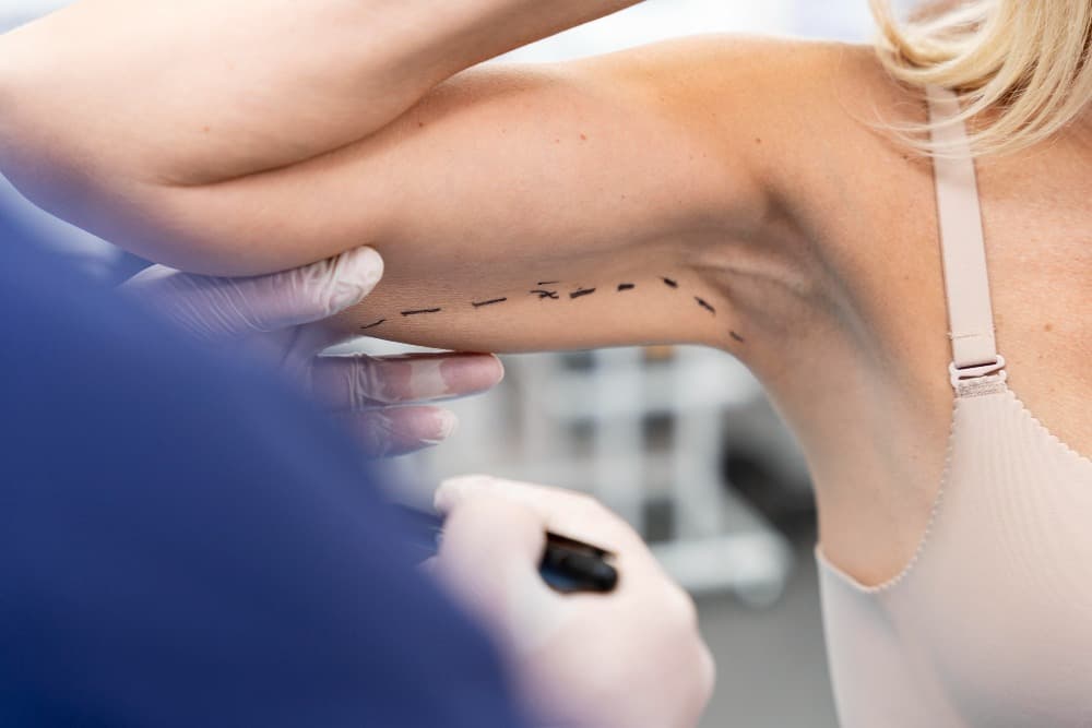 Conheça a Braquioplastia: Cirurgia Plástica nos Braços
