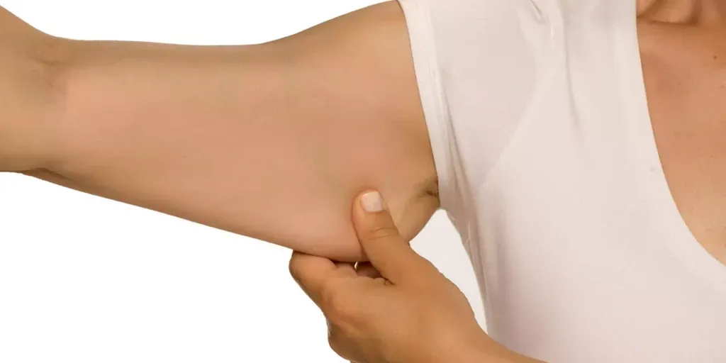 Conheça a Braquioplastia: Cirurgia Plástica nos Braços