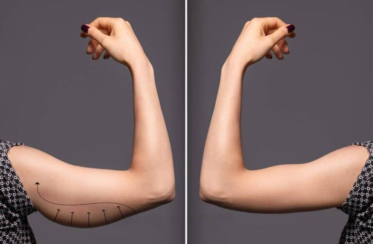 Conheça a Braquioplastia: Cirurgia Plástica nos Braços
