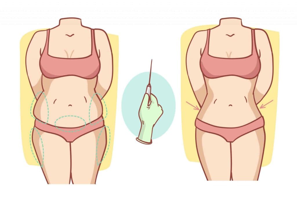 Em quais áreas do corpo a Lipoaspiração pode ser feita?