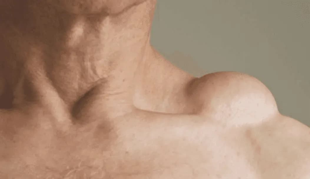 RETIRADA DE LIPOMA — Pequenos procedimentos